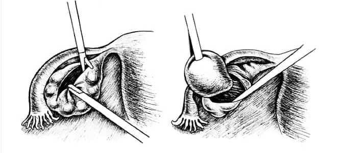 Цель проведения цистэктомии яичника