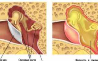 Как лечить отит среднего уха