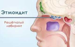 Этмоидит у взрослых и детей
