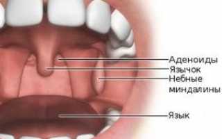 Что такое аденоиды