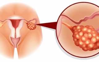 Лапароскопическая операция при поликистозных яичниках