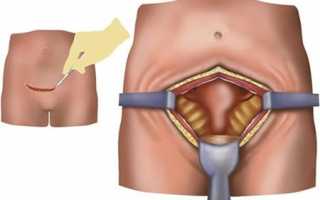 Почему врачи прибегают к лапаротомии в гинекологии