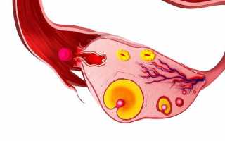 Наличие кисты желтого тела яичника у женщины и пути её лечения