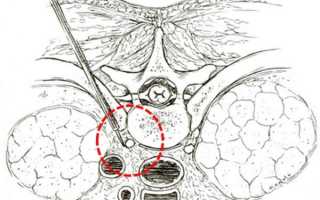 Поясничная симпатэктомия: как проводится операция