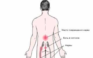 Радикулит: всё, что нужно знать о заболевании