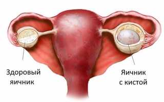 Механизм и причины образования ретенционной кисты яичника
