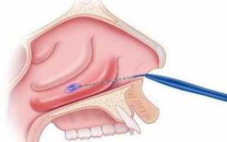 Вазотомия носа